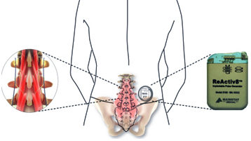 ReActiv8 – Restorative Nerve Stimulation for Back Pain