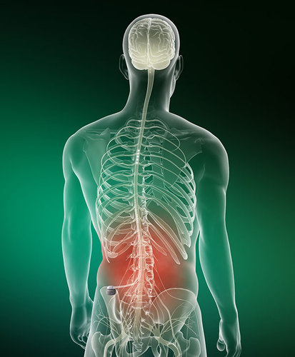 Spinal Cord Stimulation (SCS) For Chronic Pain