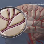 cost-of-clot-busting-altepase-outpaces-us-reimbursement