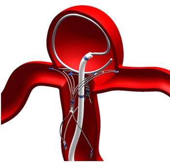 ANSWER study for wide-neck aneurysms meets primary endpoints ...