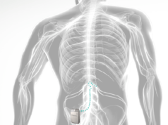 Evidence in favour of DRG stimulation builds with real-world data