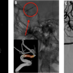 Case of DCB