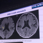 DWI-FLAIR mismatch