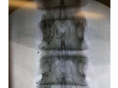 Pooled analysis finds dorsal root ganglion stimulation “safe and effective” for multiple chronic pain disorders