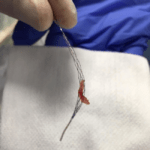 Rapid Medical clot photo