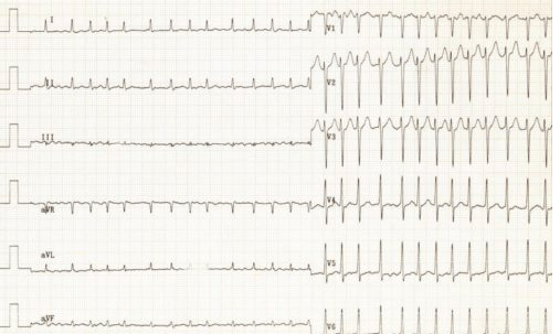 News from SNIS: Bridging therapy independently predicts haemorrhagic ...