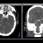 basilar artery occlusion