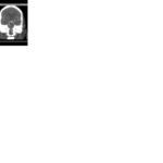 basilar artery occlusion