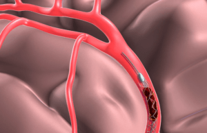 mechanical thrombectomy alone