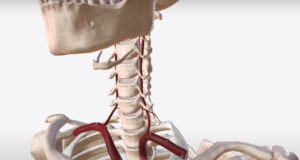 vertebral artery stenting