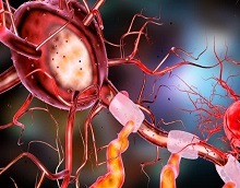 repeated clot retrieval stroke