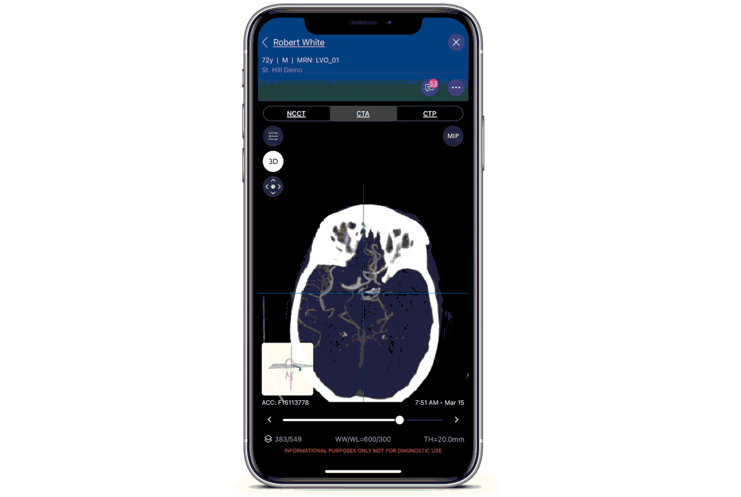 Viz.ai debuts Viz ANX for cerebral aneurysm detection at SVIN 2021