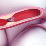 brain clot aha featured