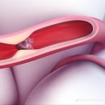 brain clot aha thumbnail