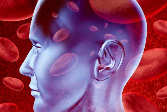 US patient safety metric “fundamentally flawed” for thrombectomy and could lead to stroke centres being “unfairly penalised”