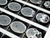 AI-enabled NeuroDR software for neurovascular imaging gains US FDA 510(k) clearance