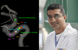 Study finds “eye-opening” variability across physician estimations of flow-diverter deployment