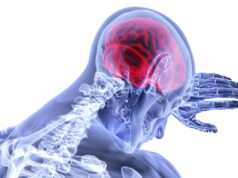 Transradial achieves non-inferiority but procedural delays may mean femoral access remains default in stroke thrombectomy