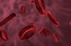 Global experts call for tighter standards to speed up emergency haemorrhagic stroke treatment