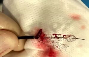 Dual-stent retriever strategy demonstrates promise in TWIN2WIN clinical trial