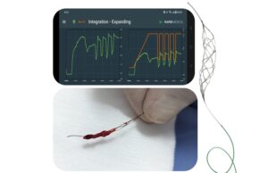 Rapid Medical completes successful stroke procedures with “world’s first” robotic thrombectomy device