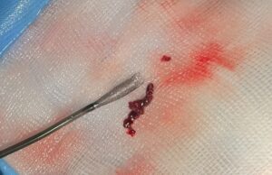 Ceretrieve announces successful results in FIH study of stroke aspiration catheter