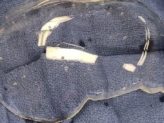 US researchers pioneer new brain imaging technique through ‘clear window’ in patient’s skull