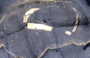 US researchers pioneer new brain imaging technique through ‘clear window’ in patient’s skull