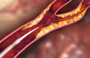 InspireMD congratulates CREST-2 investigators on completion of trial enrolment InspireMD