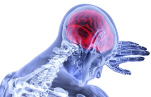 High blood pressure, atrial fibrillation and smoking among risk factors for severe stroke, study finds