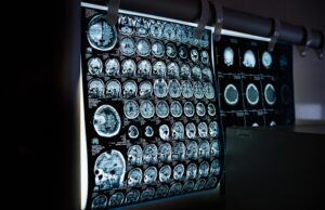 SyntheticMR highlights multicentre study demonstrating diagnostic equivalence between SyMRI technology and conventional MRI