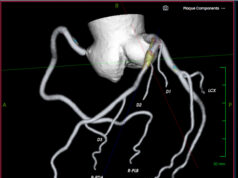 Elucid launches lesion inspection tool for coronary and carotid plaque analysis