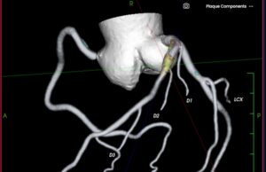Elucid launches lesion inspection tool for coronary and carotid plaque analysis