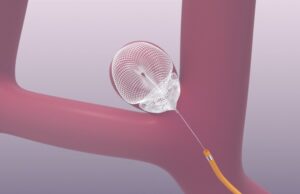 Galaxy submits final PMA module for Seal device in wide-neck bifurcation aneurysms