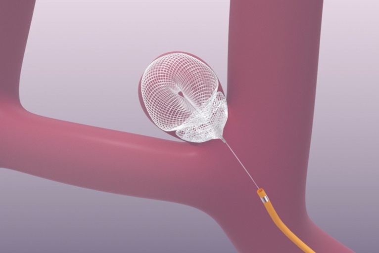 Extraluminal Device Examples Galaxy submits final PMA module for Seal device in wide-neck ...