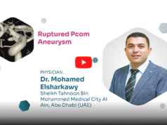 Proctor Picks: ruptured PCom aneurysm treatment using Avenir Pico coils
