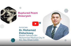 Proctor Picks: ruptured PCom aneurysm treatment using Avenir Pico coils