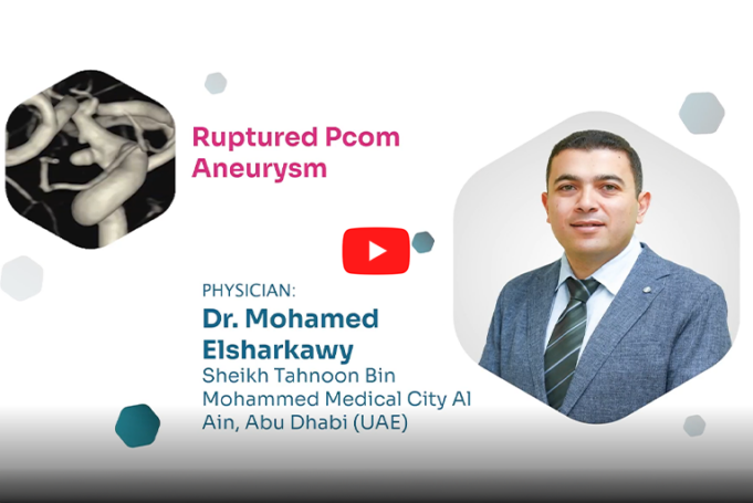Proctor Picks: ruptured PCom aneurysm treatment using Avenir Pico coils