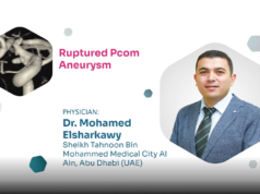 Proctor Picks: ruptured PCom aneurysm treatment using Avenir Pico coils