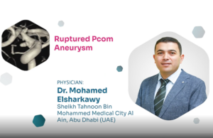 Proctor Picks: ruptured PCom aneurysm treatment using Avenir Pico coils