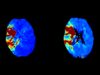 Cercare announces US FDA clearance of CBCT perfusion solution in acute stroke imaging