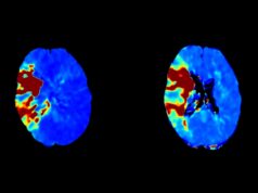 Cercare announces US FDA clearance of CBCT perfusion solution in acute stroke imaging
