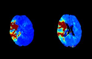 Cercare announces US FDA clearance of CBCT perfusion solution in acute stroke imaging