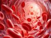 Arterial widening identified as potential underlying cause of small vessel disease and lacunar stroke