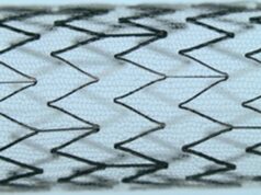 CGUARDIANS II shows positive 30-day outcomes for carotid stent use in TCAR procedures