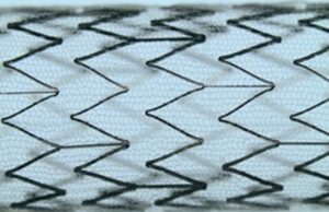 CGUARDIANS II shows positive 30-day outcomes for carotid stent use in TCAR procedures