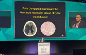 “The low-hanging fruit is gone”: larger trials and more proactive treatment key to further advancing stroke thrombectomy