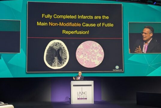 “The low-hanging fruit is gone”: larger trials and more proactive treatment key to further advancing stroke thrombectomy