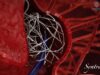 Arissa Medical announces 12-month clinical results with Syntra device in complex brain aneurysms