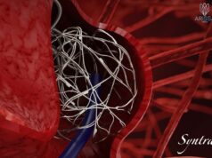 Arissa Medical announces 12-month clinical results with Syntra device in complex brain aneurysms
